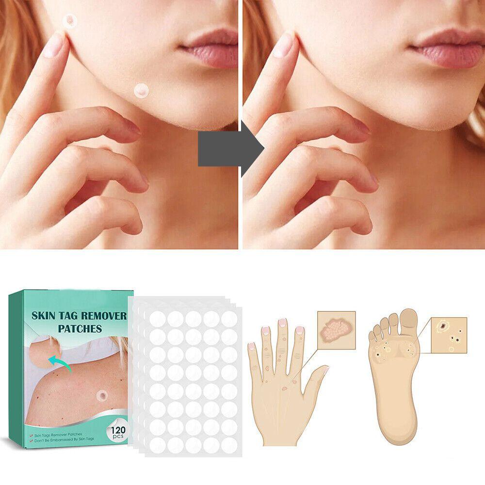 Ripob | SkinClear Hautwarzenentferner | Pflaster zur Entfernung von Hautwarzen & Warzen | Hydrocolloid-Technologie | Schmerzfrei & Diskret | Für alle Hauttypen geeignet | 144 Stück